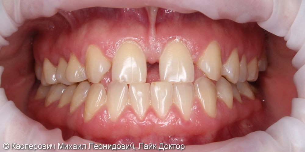 Устранения диастемы между зубами - фото №1