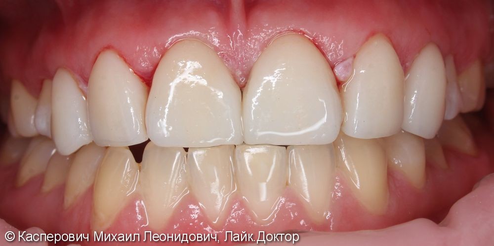 Устранения диастемы между зубами - фото №4