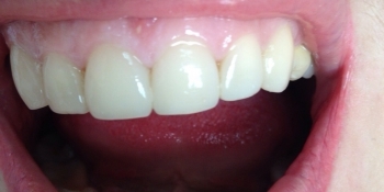 Реставрация верхних передних зубов - фото №2