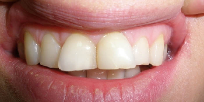 Эстетическая реставрация верхнего зубного ряда - фото №1