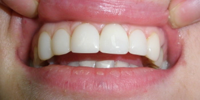 Эстетическая реставрация верхнего зубного ряда - фото №2