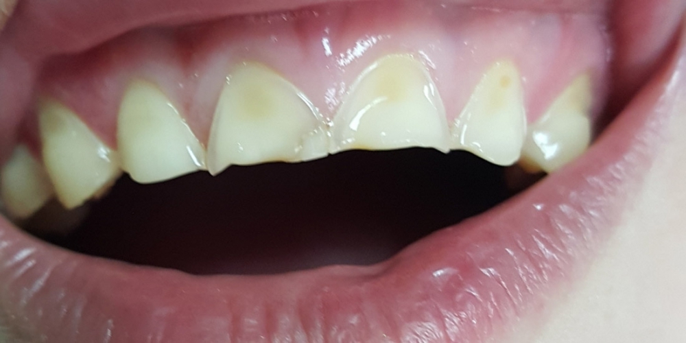 Эстетическая реставрация 10 передних зубов в цвет - фото №1