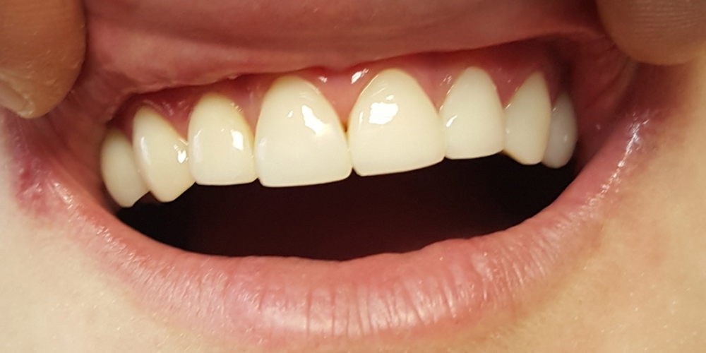 Эстетическая реставрация 10 передних зубов в цвет - фото №2