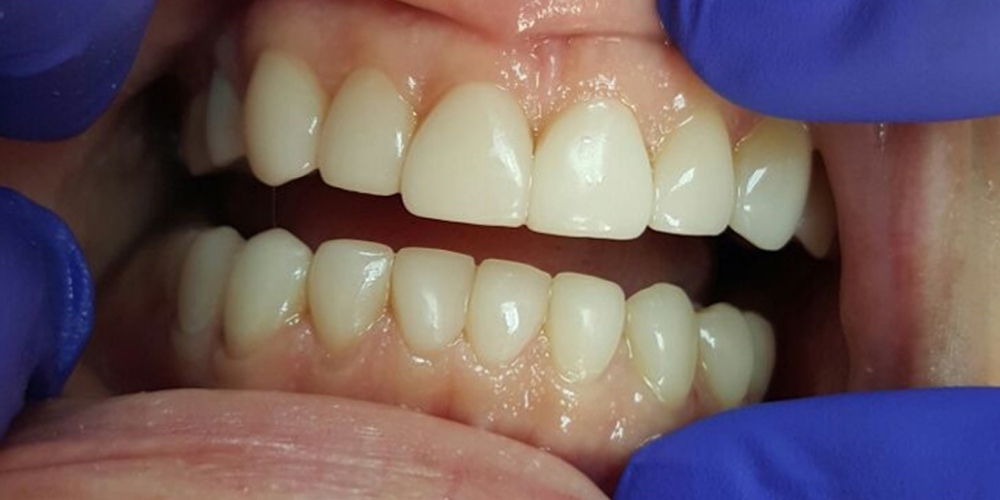 Эстетическая реставрация зубов за 2 приема - фото №2