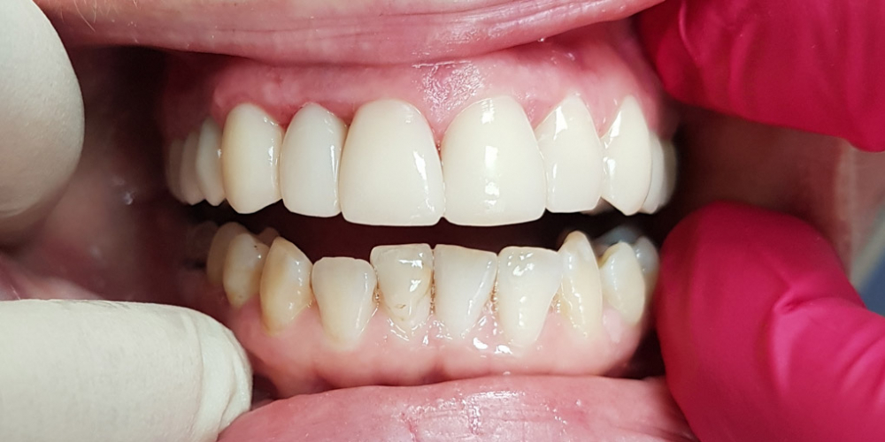 Эстетическая реставрация переднего зуба - фото №2