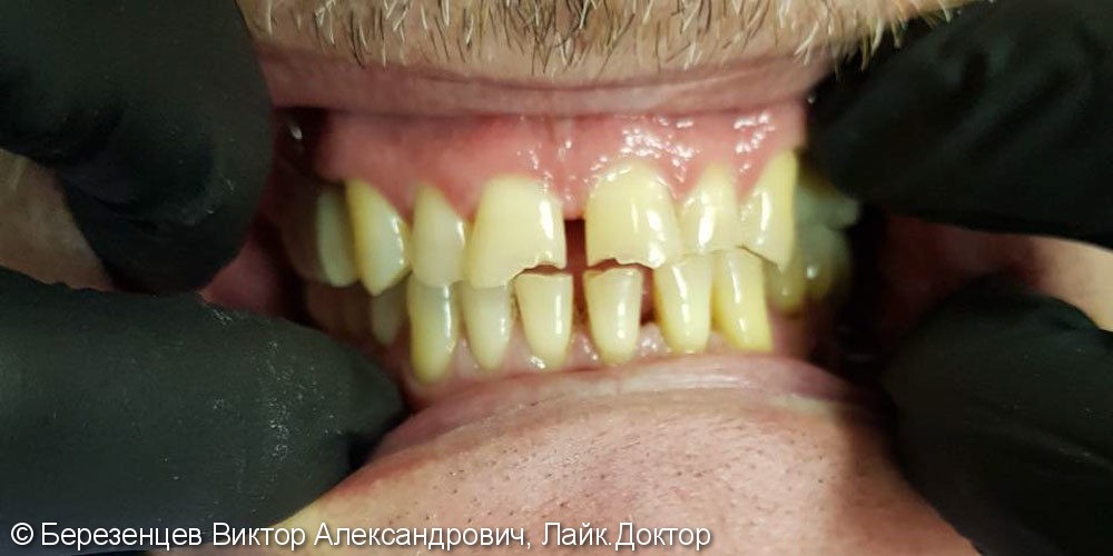 Устранение тремы между передними зубами, до и после - фото №1