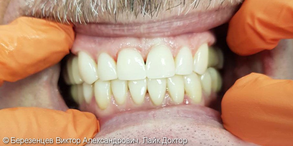 Устранение тремы между передними зубами, до и после - фото №2