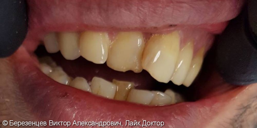 Эстетическая реставрация передних зубов верхней и нижней челюсти - фото №1