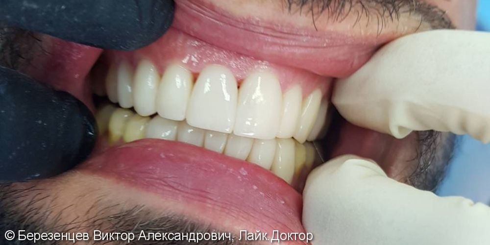 Эстетическая реставрация передних зубов верхней и нижней челюсти - фото №2