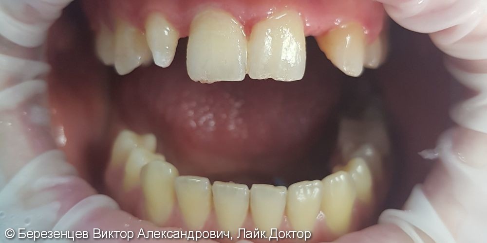Аномалия зубного ряда - фото №1