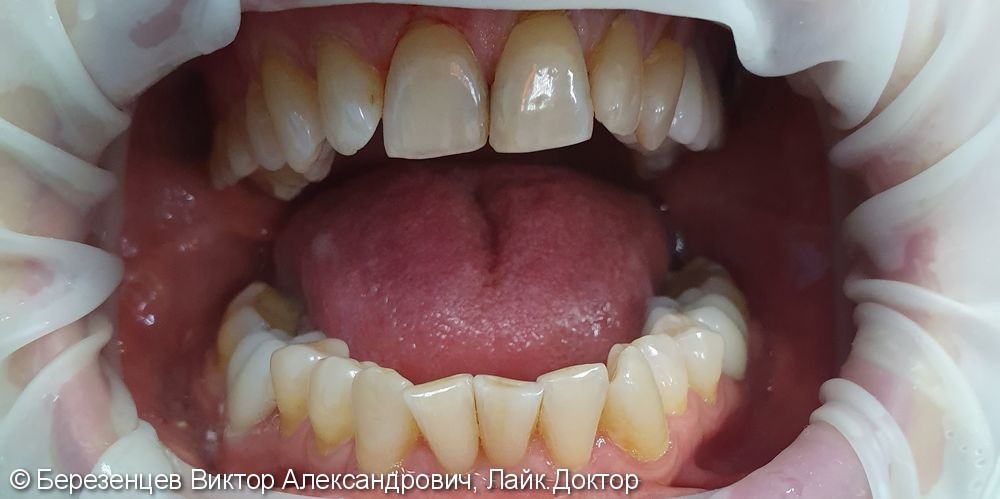 Эстетическая реставрация передних зубов верхней и нижней челюсти - фото №1