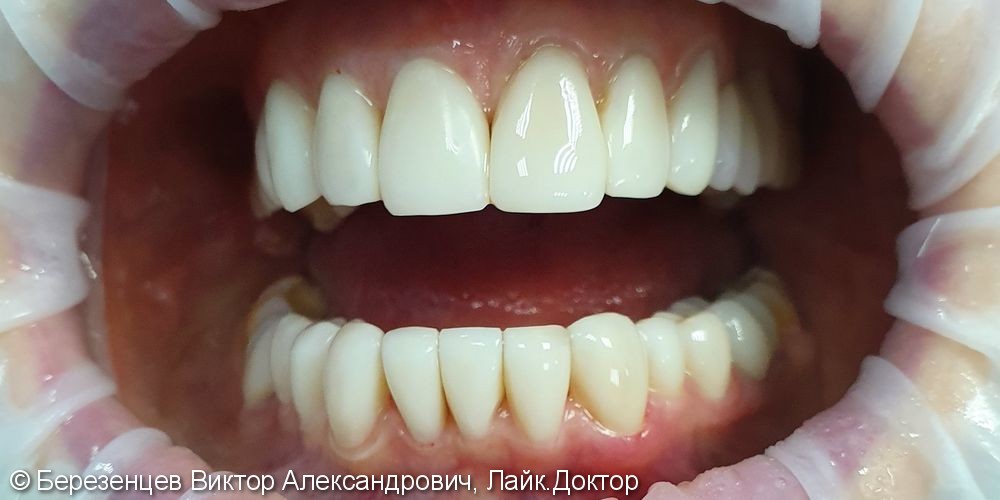 Эстетическая реставрация передних зубов верхней и нижней челюсти - фото №2