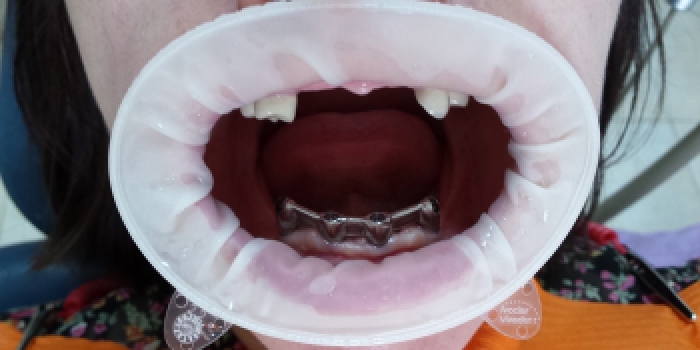 Полное восстановление отсутствия зубов нижней и верхней челюсти - фото №1