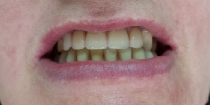 Полное восстановление отсутствия зубов нижней и верхней челюсти - фото №2