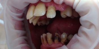 Исправление зубного ряда, санация полости рта - фото №1
