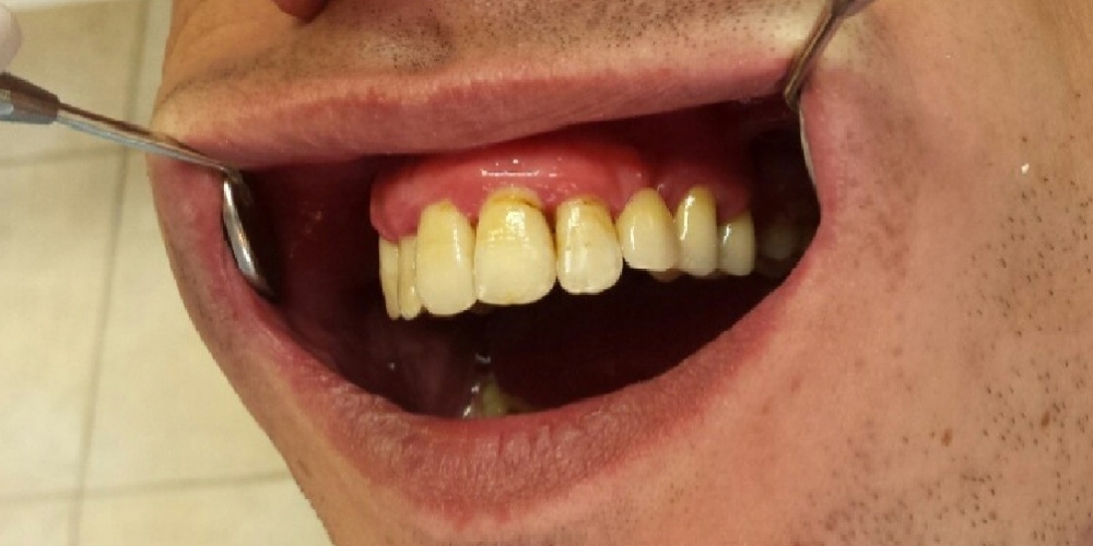 Исправление зубного ряда, санация полости рта - фото №3