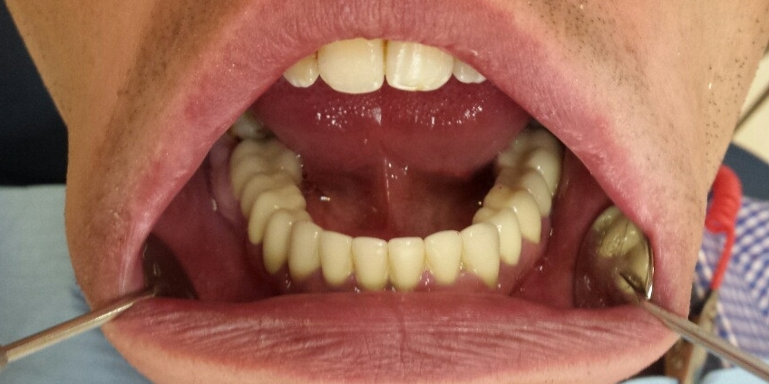 Исправление зубного ряда, санация полости рта - фото №2