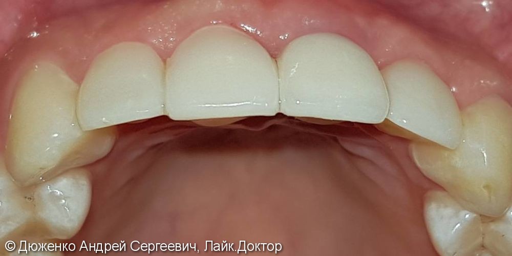 Имплантация 21 зуба, художественная эстетическая реставрация 22, 11, 12 зубов - фото №1