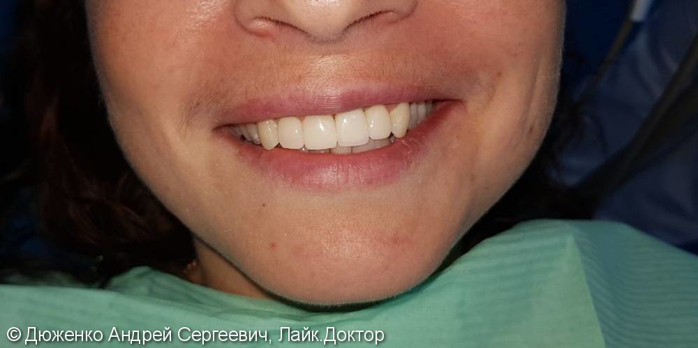 Имплантация 21 зуба, художественная эстетическая реставрация 22, 11, 12 зубов - фото №2