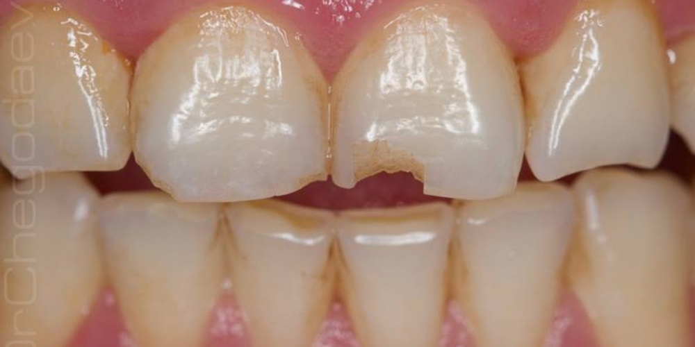 Восстановление скола переднего зуба - фото №1