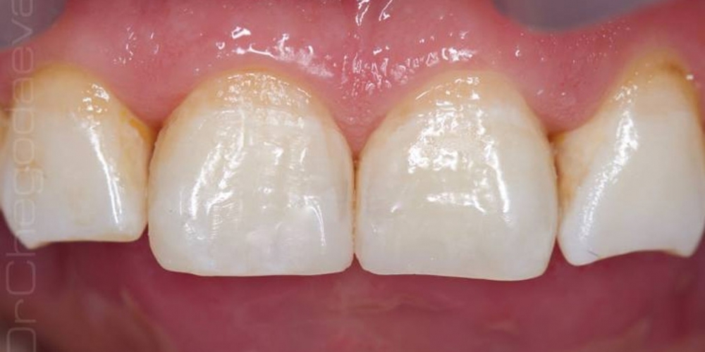 Восстановление скола переднего зуба - фото №9