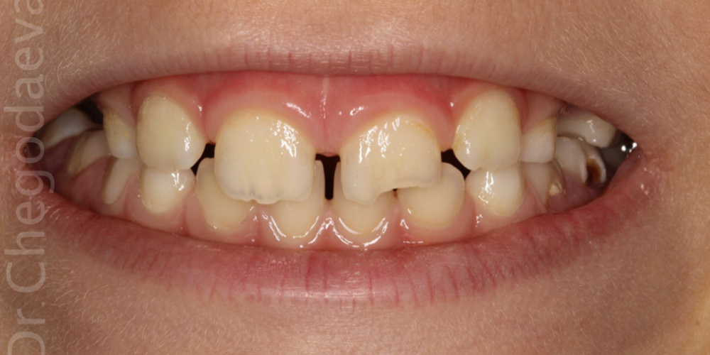 Скол постоянного переднего зуба у ребенка в пределах дентина - фото №1