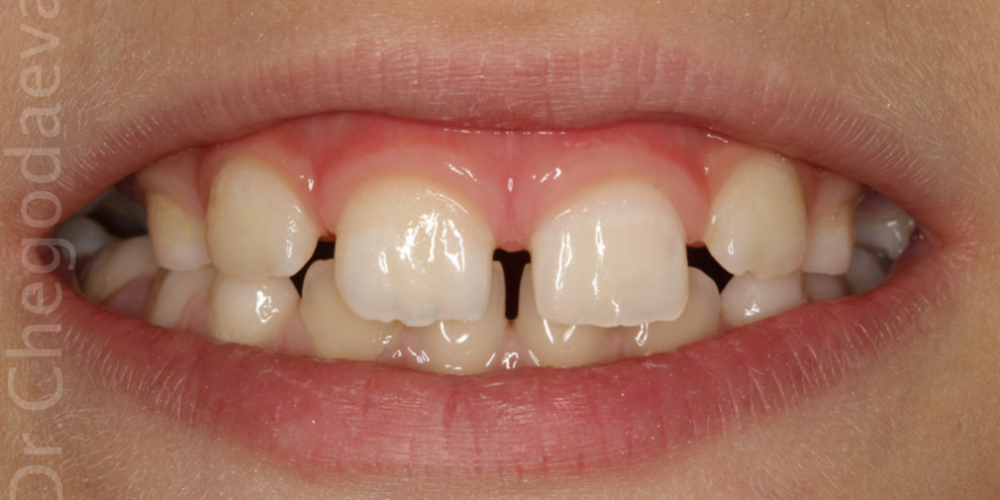 Скол постоянного переднего зуба у ребенка в пределах дентина - фото №4