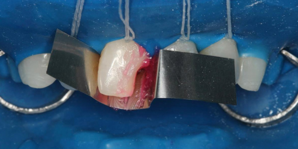 Реставрация центрального резца, неотличимая от соседнего здорового зуба - фото №4
