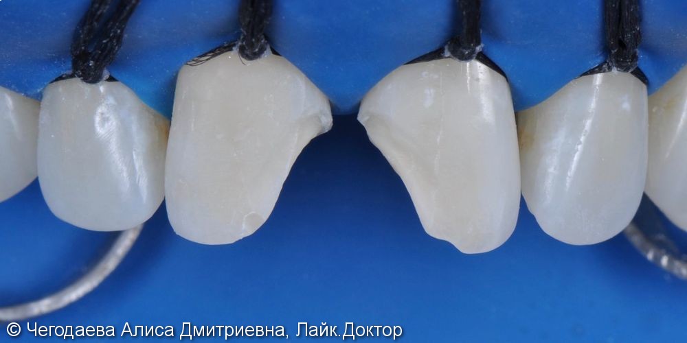 Direct restoration of teeth 1.1, 2.1 with Enamel HRi material - фото №2