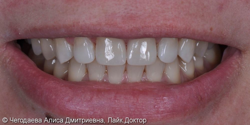 Direct restoration of teeth 1.1, 2.1 with Enamel HRi material - фото №3