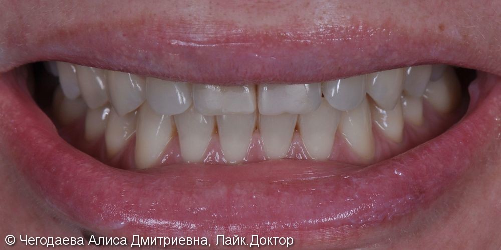 Direct restoration of teeth 1.1, 2.1 with Enamel HRi material - фото №1