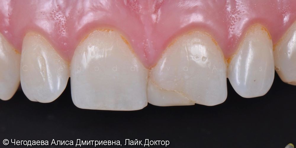 Реставрация зуба 2.1, результат до и после - фото №1