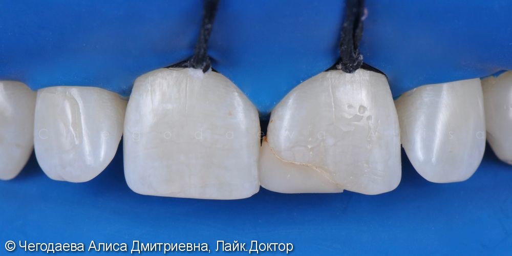 Реставрация зуба 2.1, результат до и после - фото №2