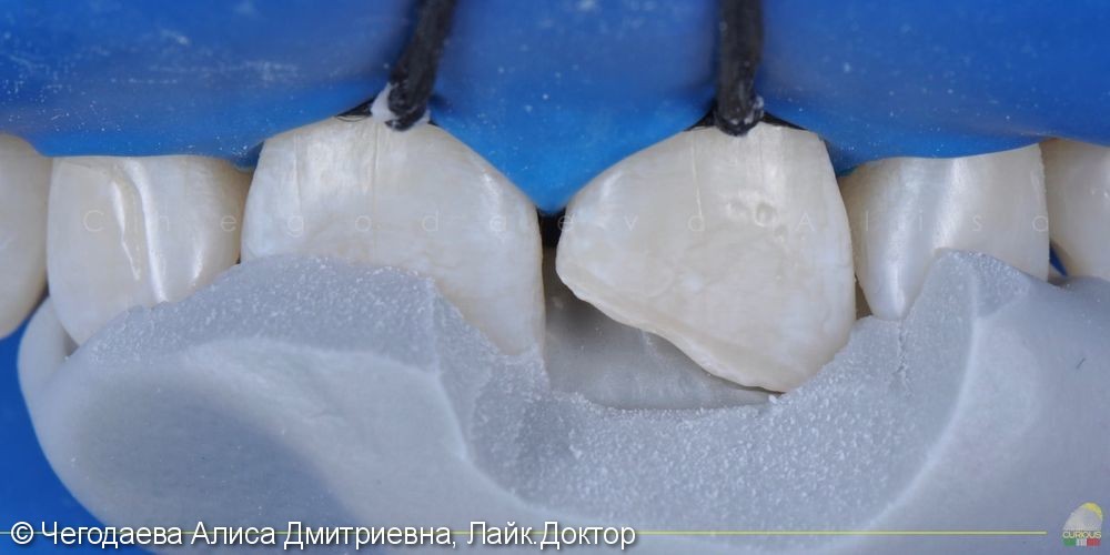 Реставрация зуба 2.1, результат до и после - фото №5