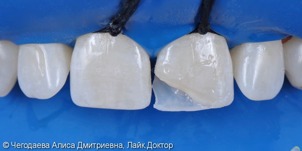 Реставрация зуба 2.1, результат до и после - фото №6