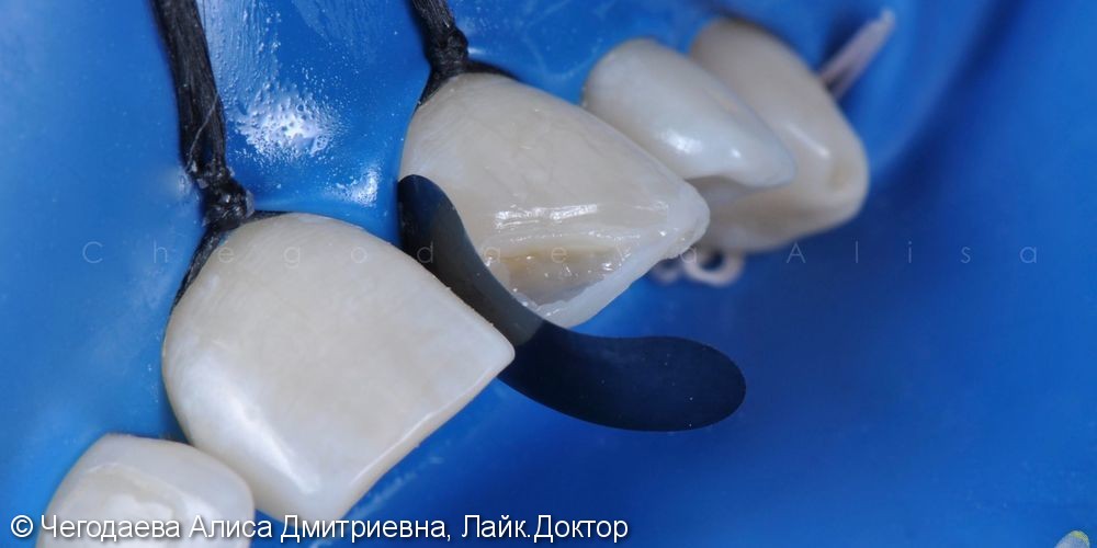 Реставрация зуба 2.1, результат до и после - фото №7