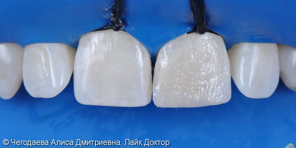 Реставрация зуба 2.1, результат до и после - фото №8