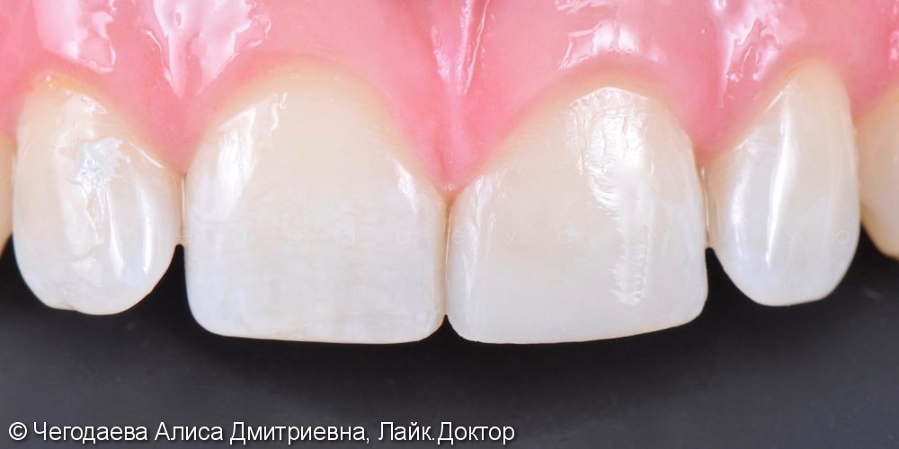 Реставрация зуба 2.1, результат до и после - фото №10