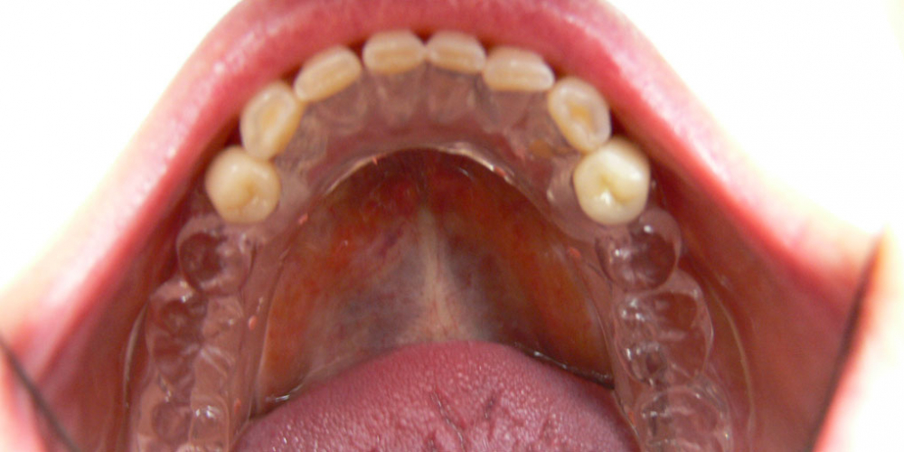 Восстановление зубов на верхней и нижней челюстях вживлением 11 имплантов - фото №3