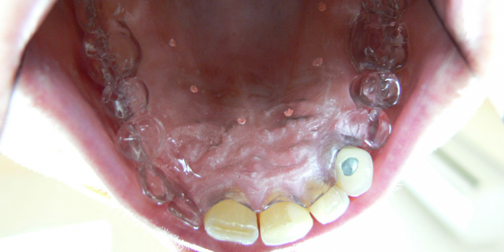 Восстановление зубов на верхней и нижней челюстях вживлением 11 имплантов - фото №4