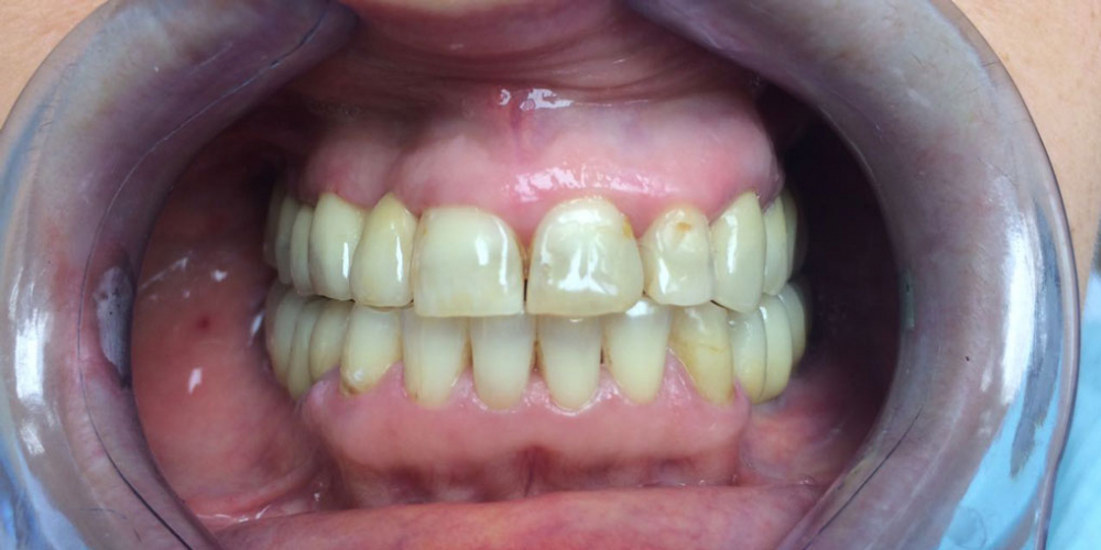 Восстановление зубов на верхней и нижней челюстях вживлением 11 имплантов - фото №2
