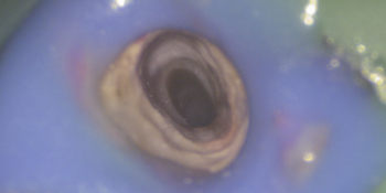 Распломбировка канала от цемента, с использованием дентального микроскопа - фото №2