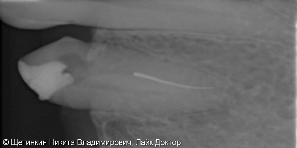 Извлечение отломока инструмента в небном канале зуба 24. под микроскопом - фото №1