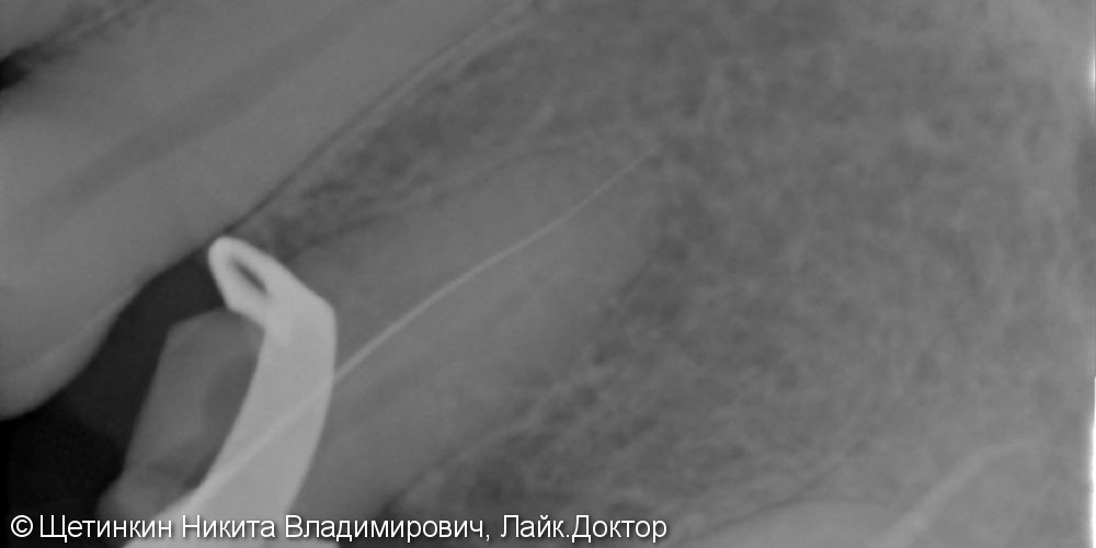 Извлечение отломока инструмента в небном канале зуба 24. под микроскопом - фото №2