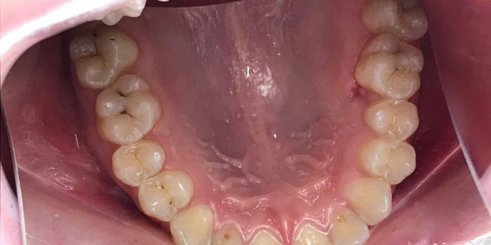 Результат лечения кариеса двух зубов - фото №1