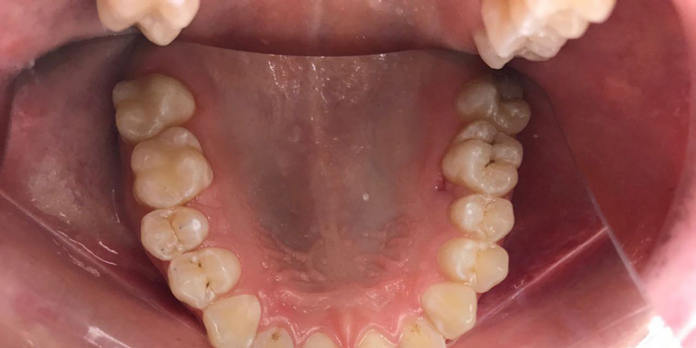 Результат лечения кариеса двух зубов - фото №2