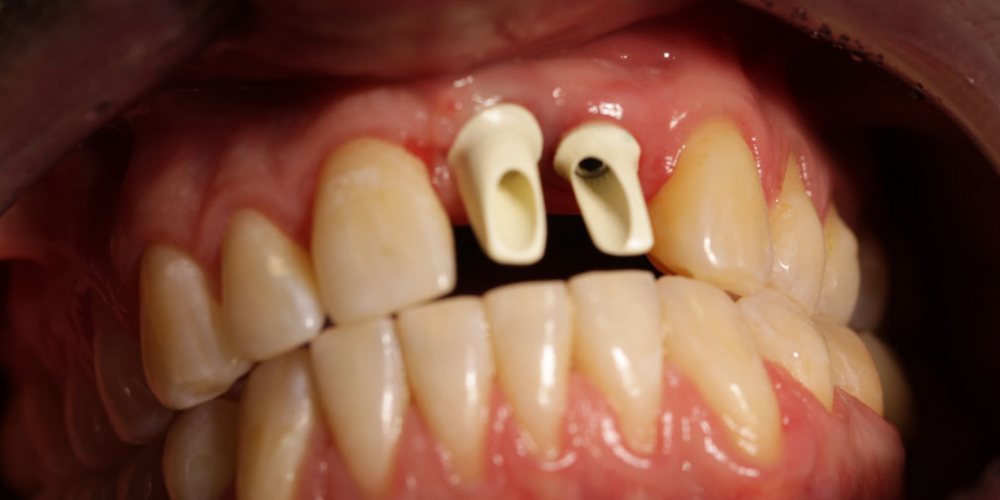 Результат имплантации и протезирования двух передних зубов - фото №2