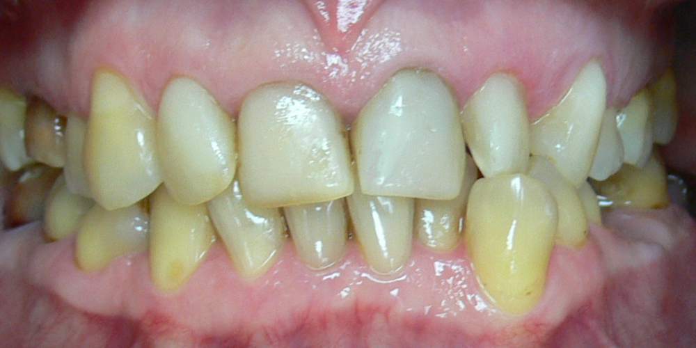 Жалобы на неровные зубы, подготовка к протезированию - фото №1