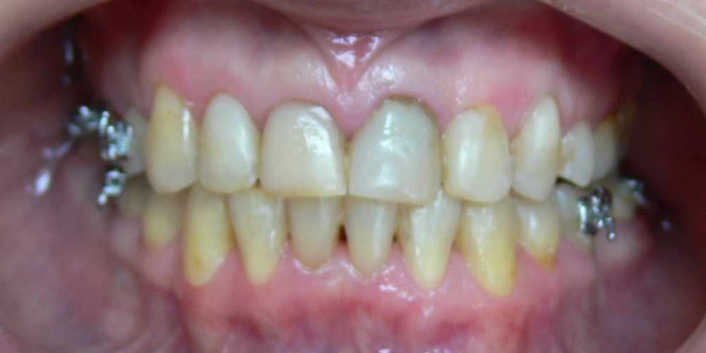 Жалобы на неровные зубы, подготовка к протезированию - фото №6