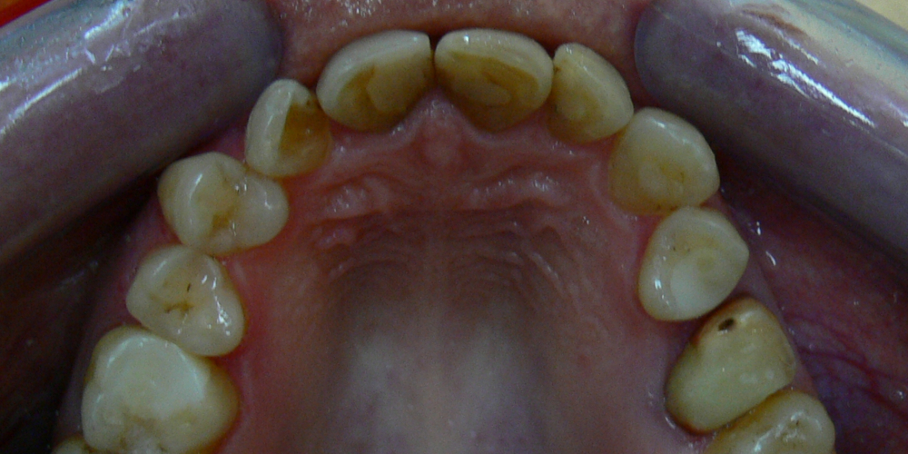Жалобы на неровные зубы, подготовка к протезированию - фото №3